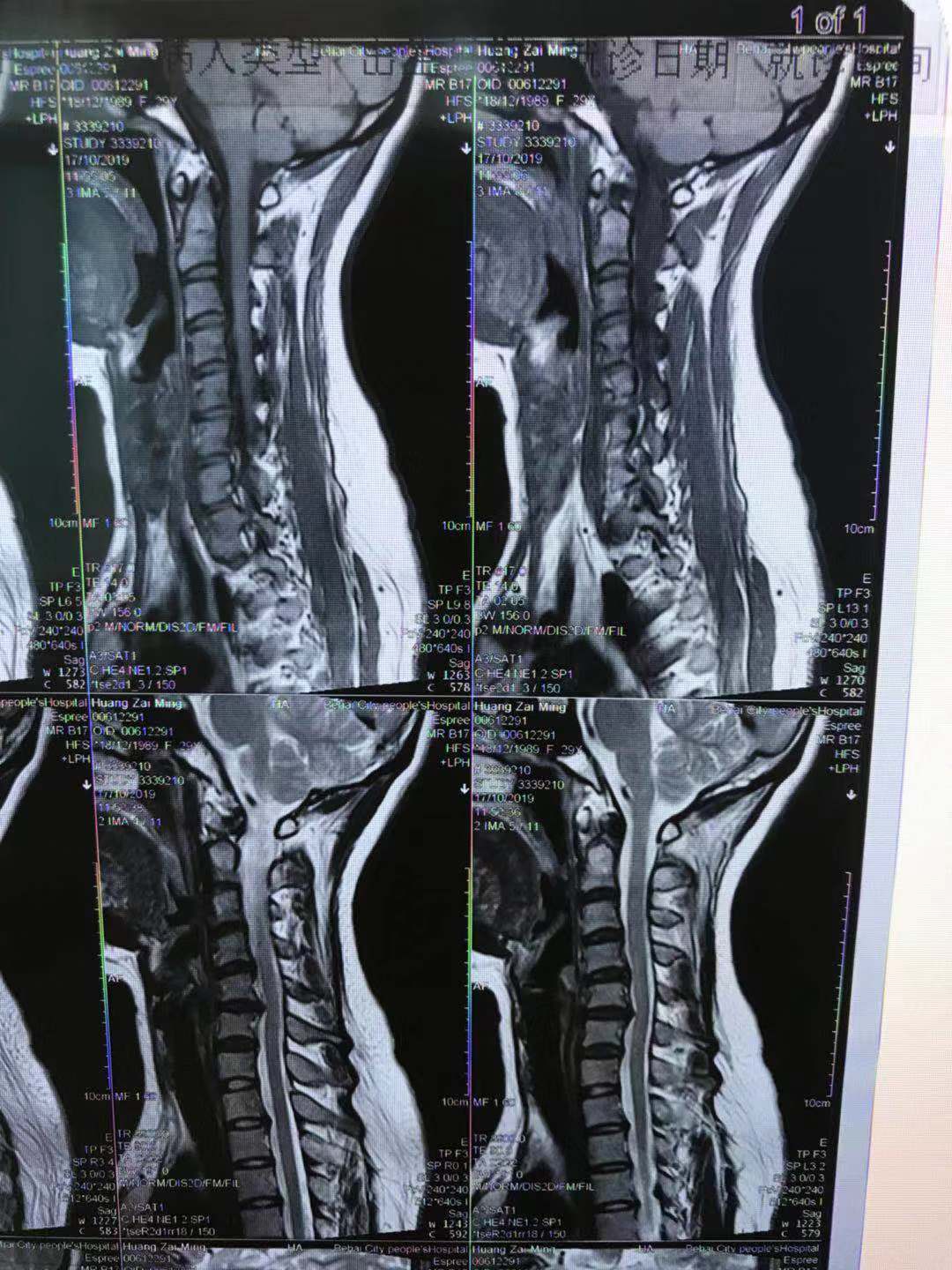 颈部疼痛:一个宝妈的痛苦