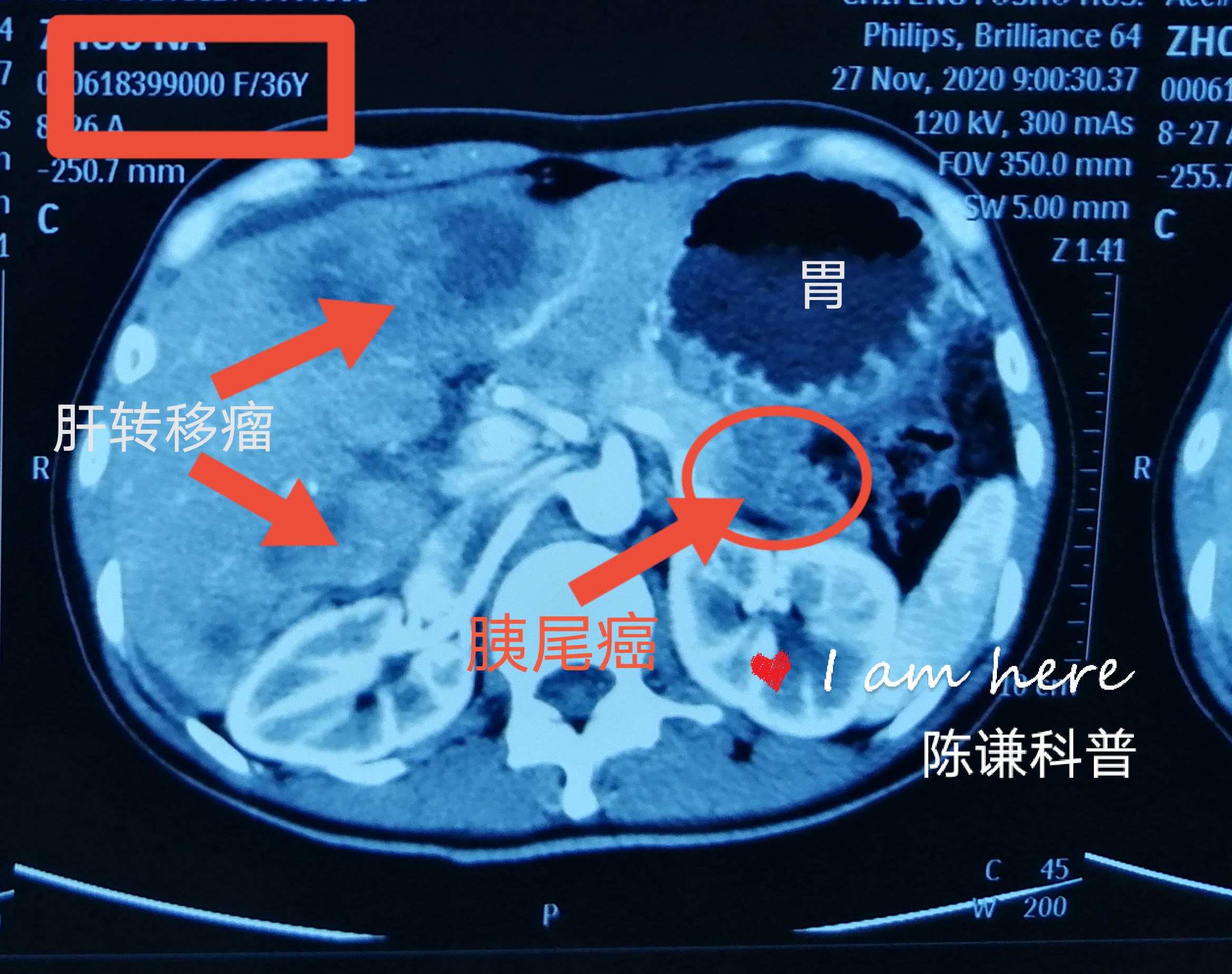 陈谦主任科普之CT检查