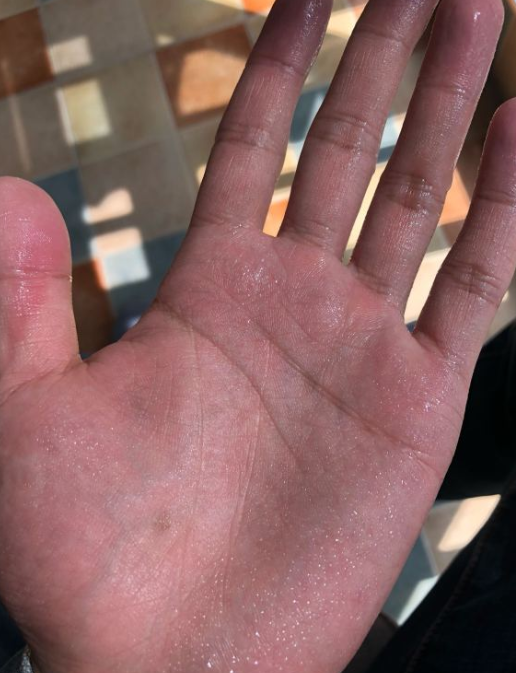 原来,自打记事起,小涛就发现自己的手特别容易出汗,无论是安静坐着
