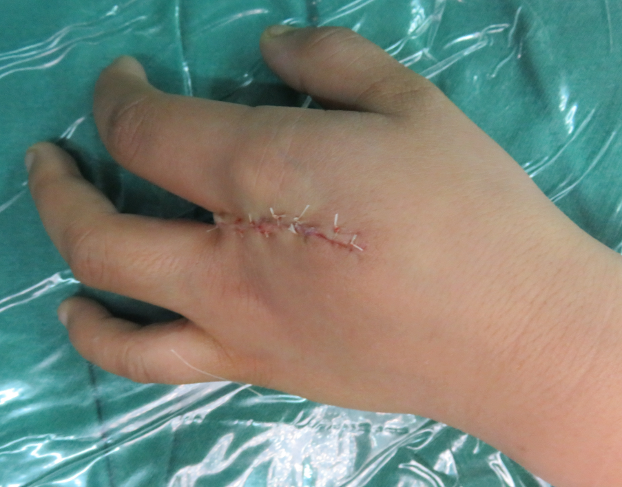 裂手畸形如何治疗