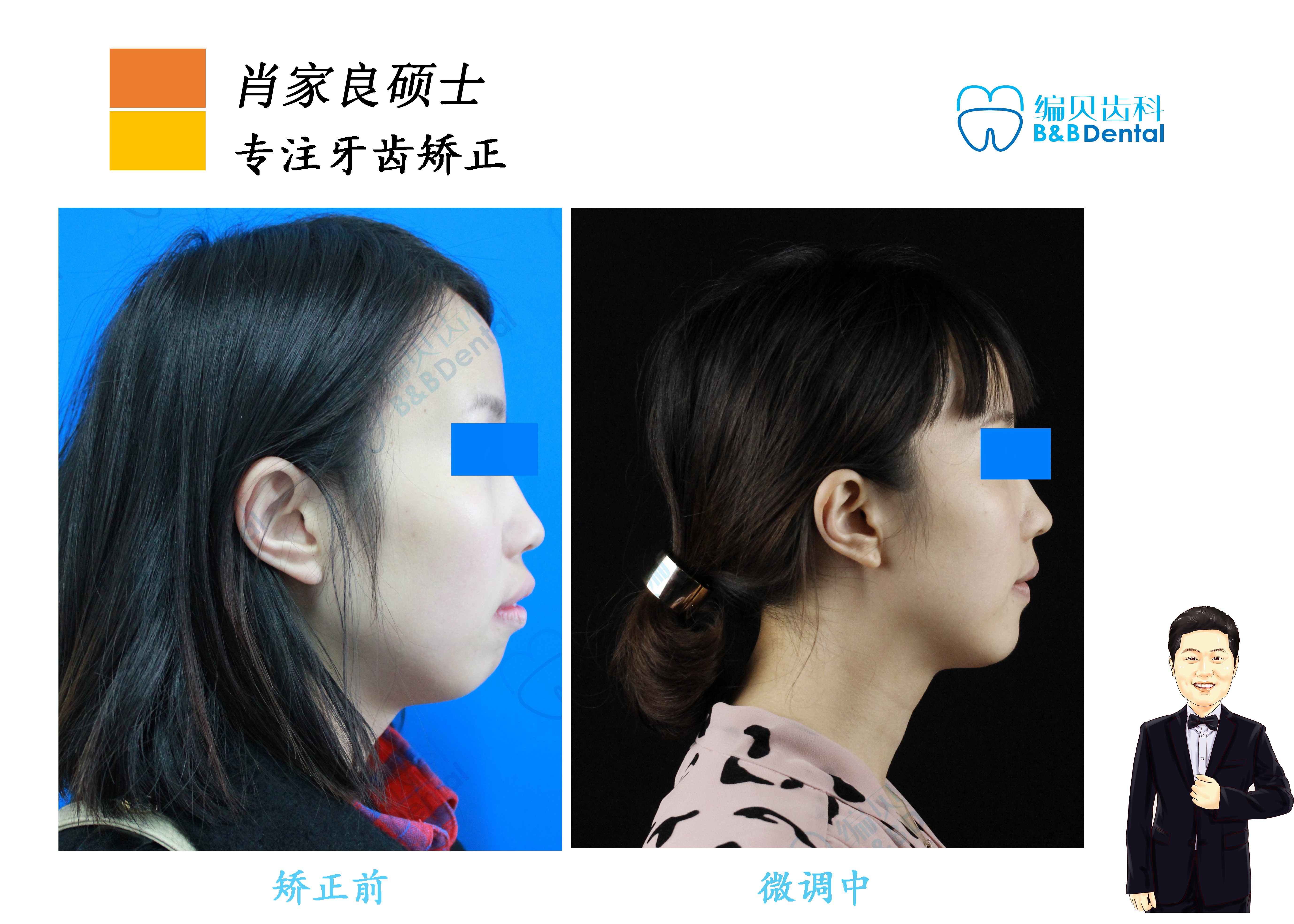支抗钉协助下利用拔牙空间内收前牙,使下颌骨逆时针旋转,塑造更好颏部