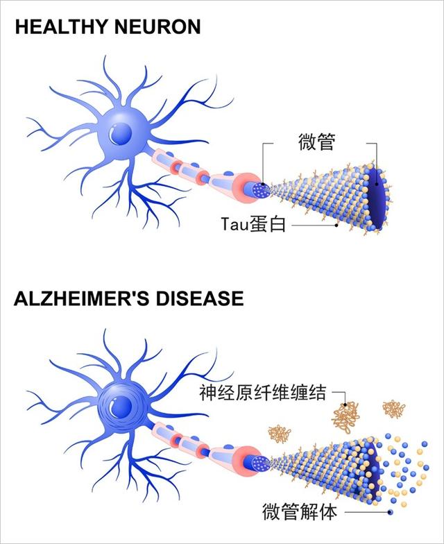 阿尔兹海默症丨老年痴呆并不遥远这个行为出现就该警惕了