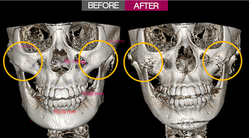 必看 下颌角术后恢复四个阶段 吴国平主任医师 爱问医生