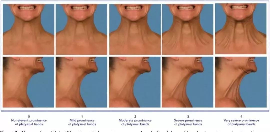 使用a型肉毒毒素注射在条索内部,可以达到松解的效果.