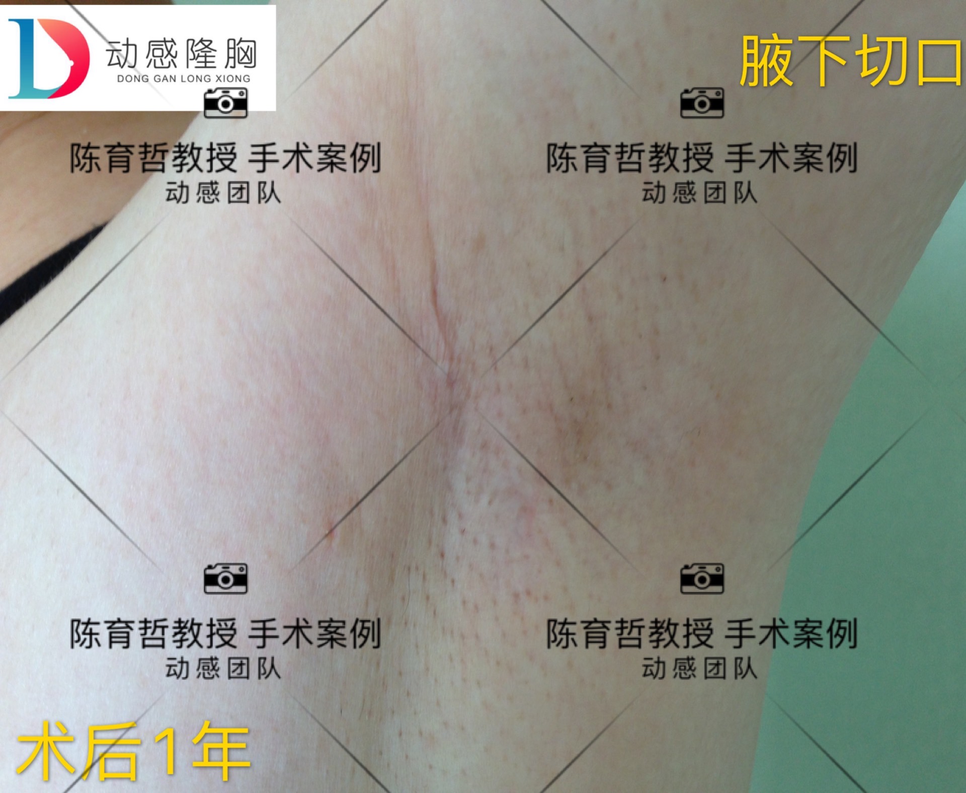 这是术后一年,腋下切口疤痕恢复的情况!你还能找到切口在哪里吗?