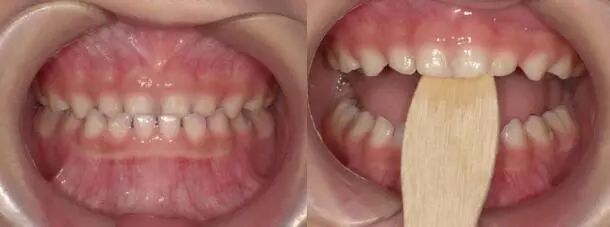 04下颌斜面导板矫治器还是简单点说,喊你把这个下颌斜面导板矫治器戴