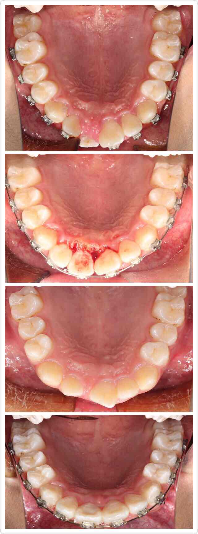 八个月,右上切牙终于归位,还需要把转矩再调整好,收一下覆盖,13岁的小