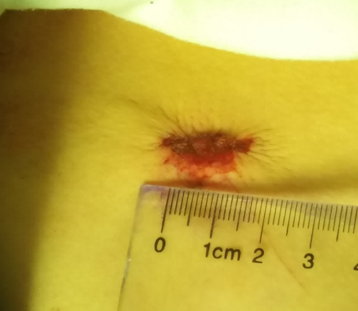 今天鸡胸"超微创"手术:无管,无胸腔镜,微小切口(1cm)