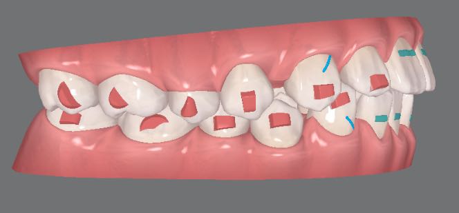 隐形矫正中附件的作用是什么?