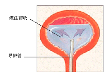 膀胱热灌注图片