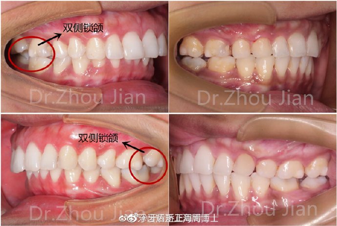 什么是锁合锁合如何解除