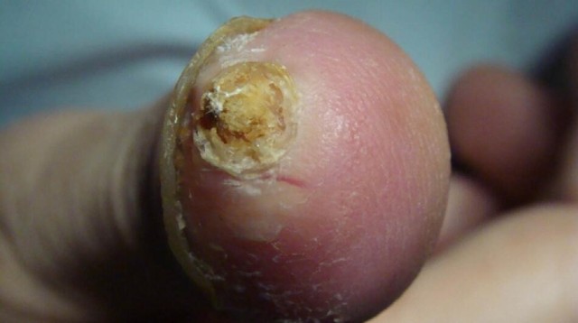 甲母质瘤治疗方法手术