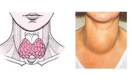 摸肿块周围有无淋巴结:若在甲状腺肿块同侧颈部能触摸到质地较硬的