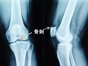 膝关节外侧间隙位置图图片