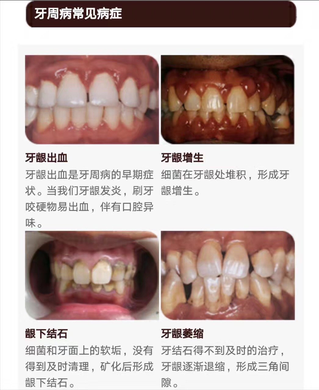 牙周炎能矫正牙齿吗?