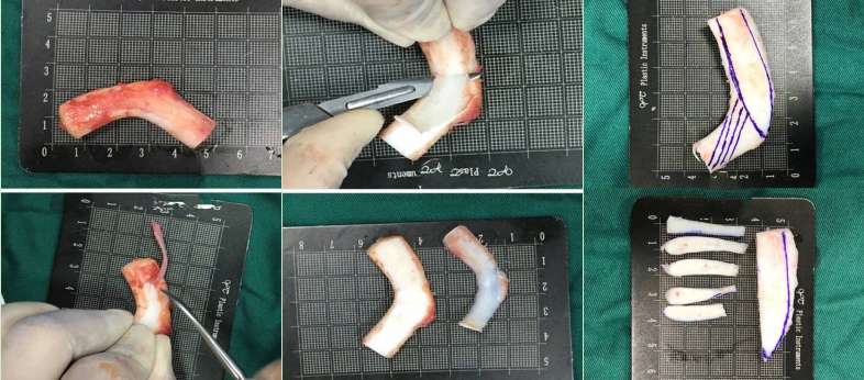 深度解读鼻综合中肋软骨的处理方式