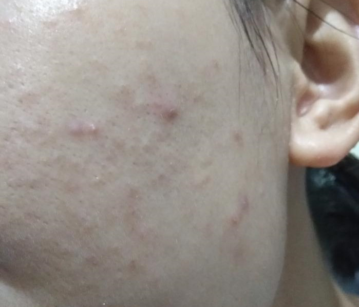 4,爆痘身体对外界刺激的不正常反应,春季是皮肤最易过敏的季节,空气中