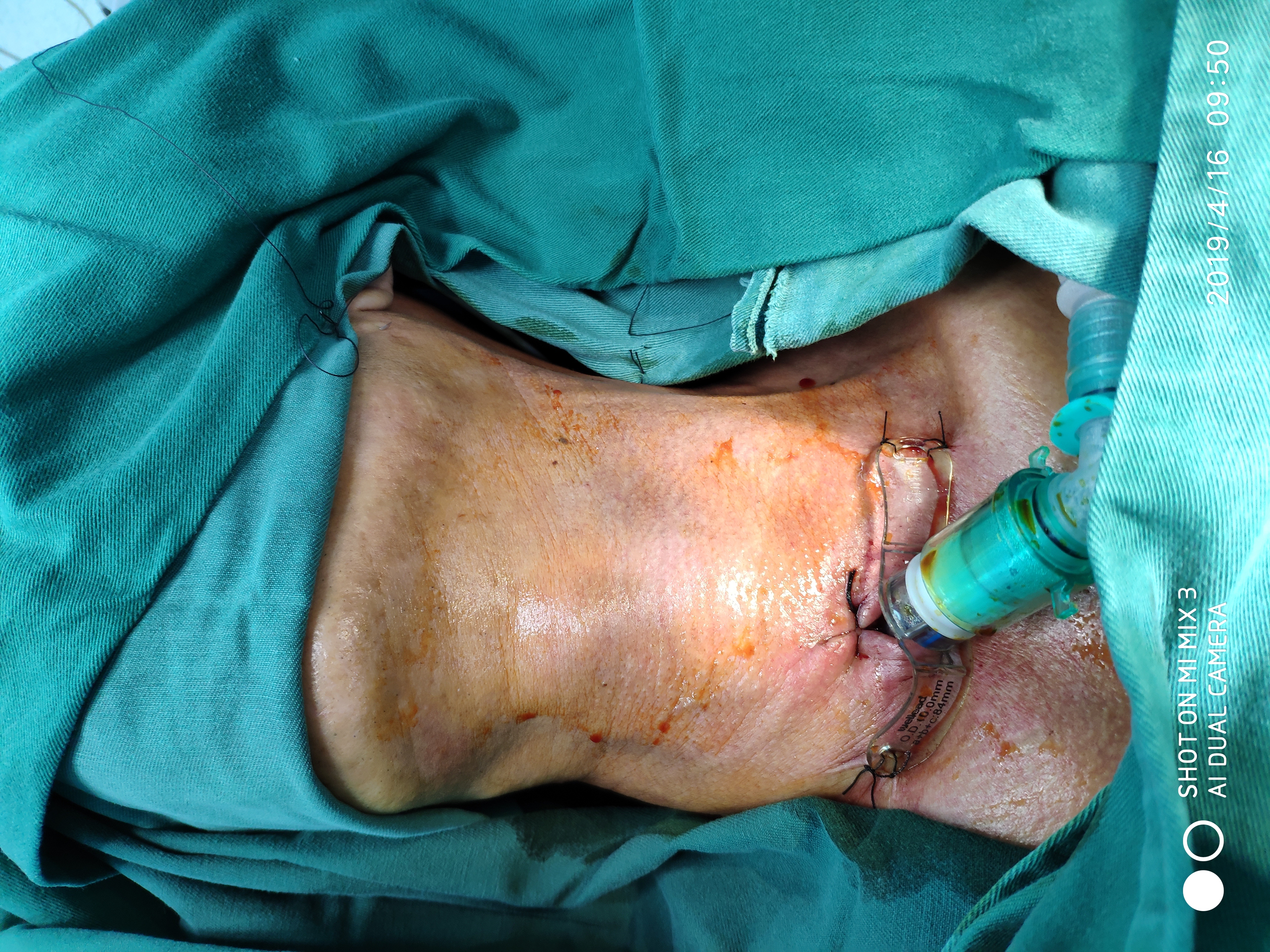 舌根癌扩大切除加皮瓣修复加术中放疗