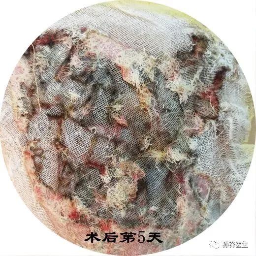 手術筆記|一期原位皮膚適形移植(ssg)治療臀部化膿性汗腺炎