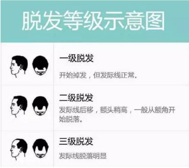脱发等级对照图,看看你到几级了?