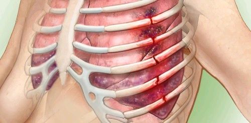 正视肋骨骨折内固定术 樊宏哲主治医师 爱问医生