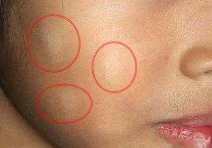 白色糠疹典型皮损为色素减退性圆形或卵圆形斑片,直径0.5-2.