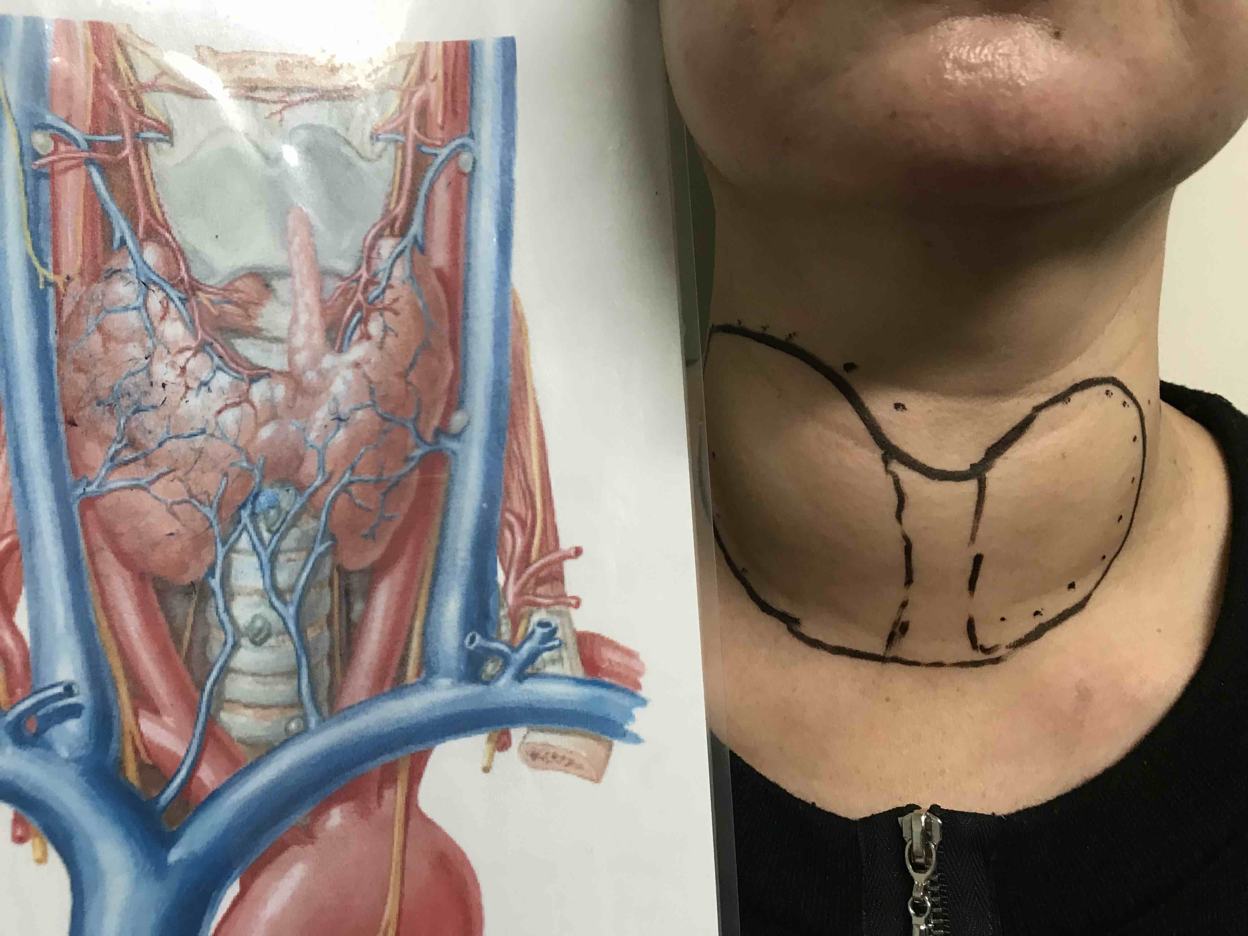 让人尴尬的颈部胖蝴蝶