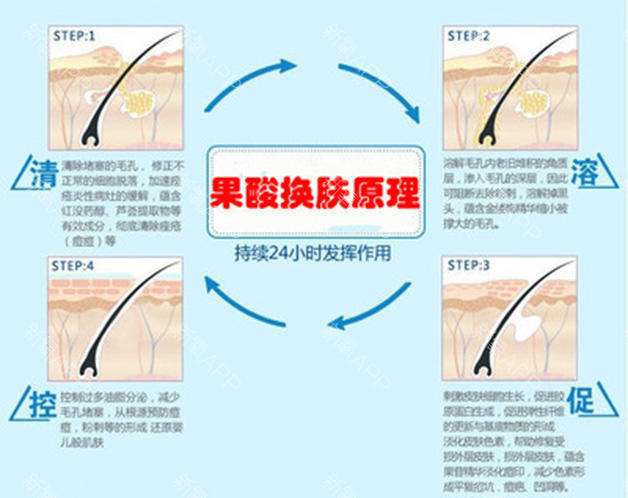 果酸焕肤是否会让皮肤变薄更容易爆痘