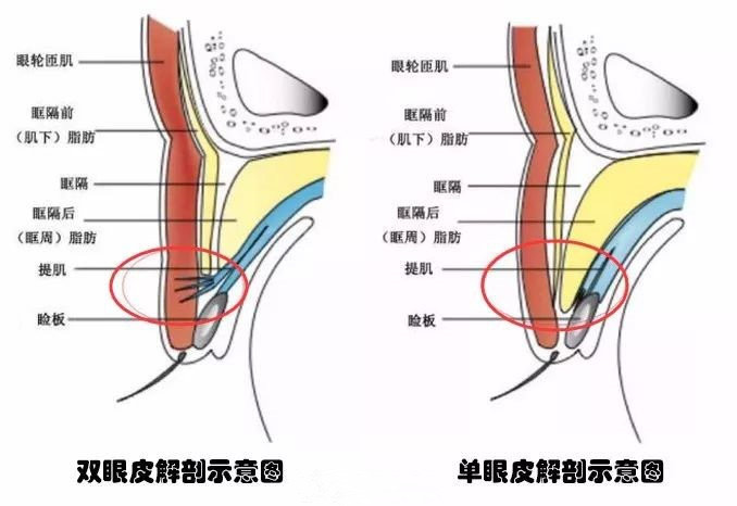 长期贴双眼皮贴能形成真正的双眼皮吗