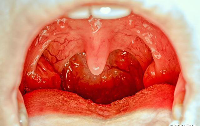 扁桃体虽小,竟然也会生癌,东方艳后确诊该病,一习惯是罪魁祸首