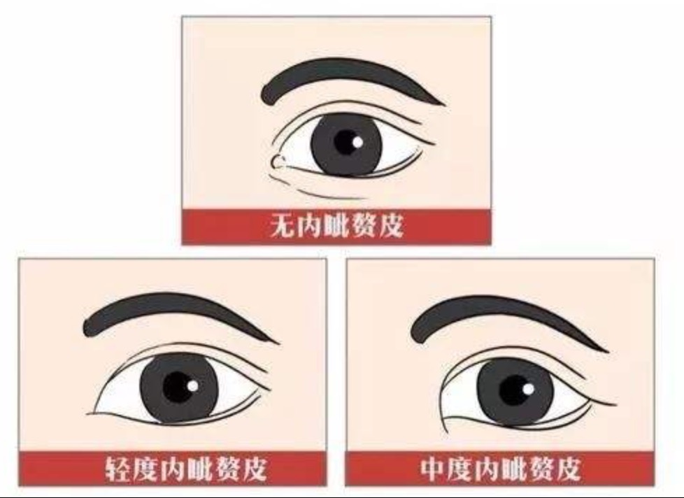 为什么双眼皮要和开眼角手术一起做