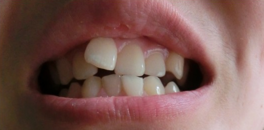 牙齿不齐是哪些原因导致的!