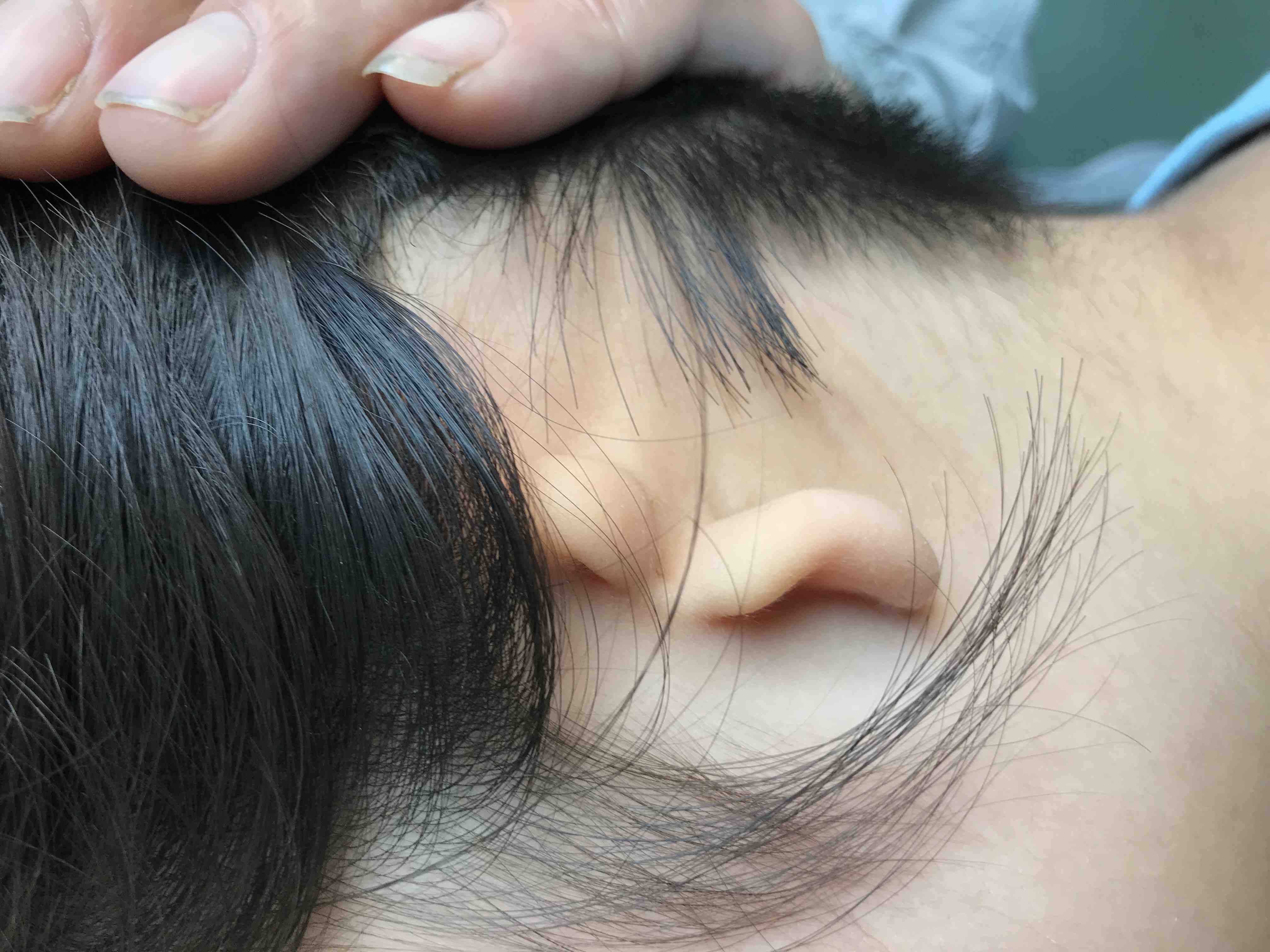 小耳畸形可以手术解决