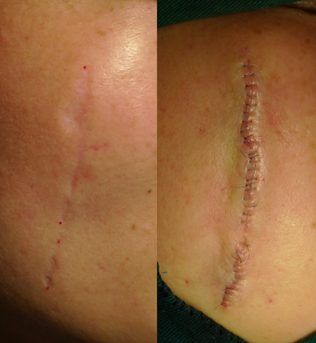 svf移植治疗凹陷性疤痕