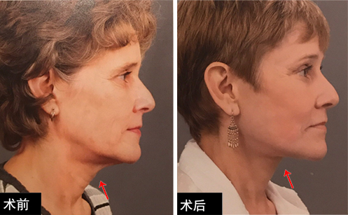 ①皮肤松弛②颏下区脂肪堆积③颈阔肌前段或后上段松弛(或僵硬)④下