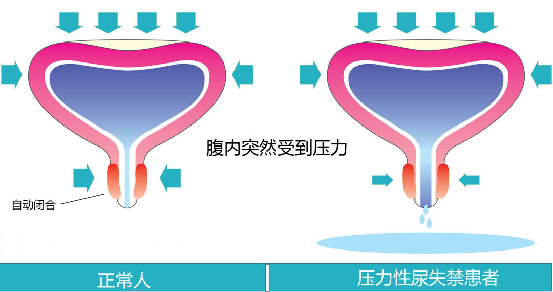 而压力性尿失禁患者的尿道无法完全闭合,举个例子就是管理膀胱的阀门