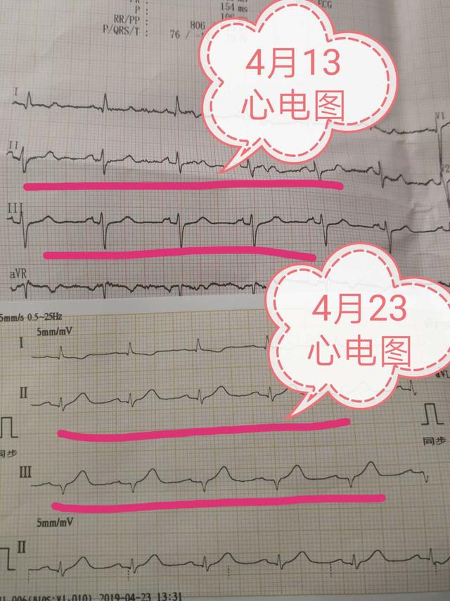 49岁,10天前检查心电图正常,现在突然心梗,120车上心脏