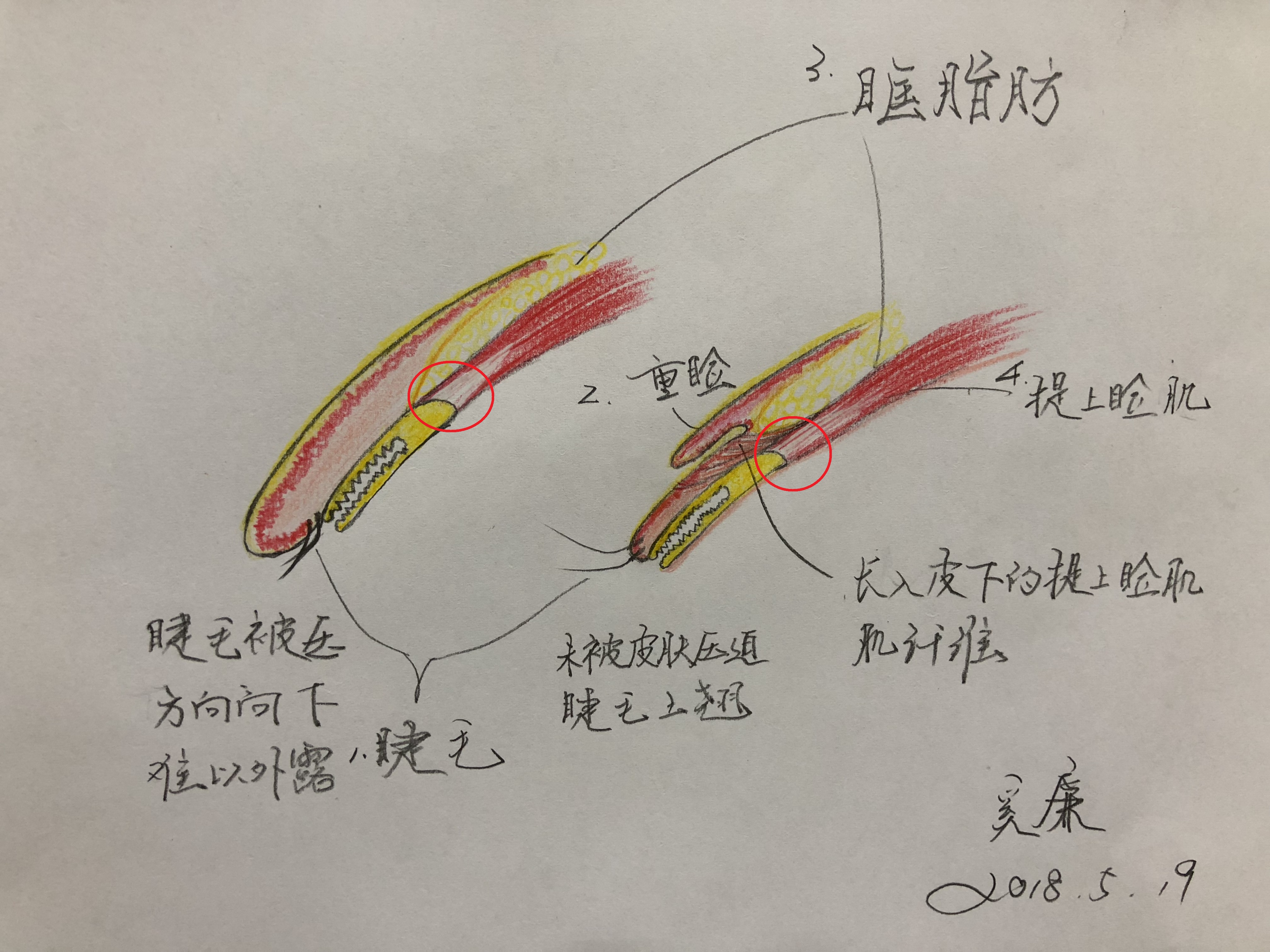 没有其他肌纤维继续生长入皮下的话,就是一个单眼皮,如果有肌纤维长入