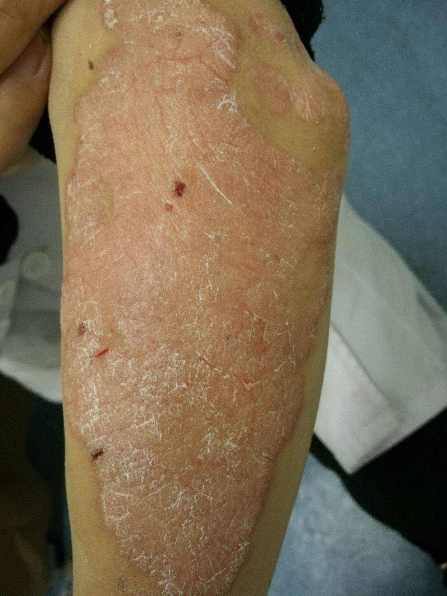 火针治疗斑块型银屑病两例病例分享