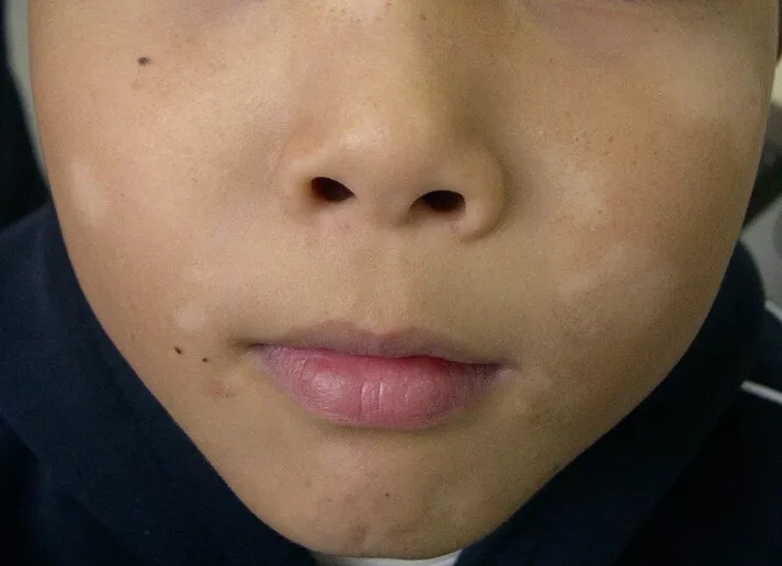 "白斑"不等于"白癜风"-杨希川主任医师-爱问医生