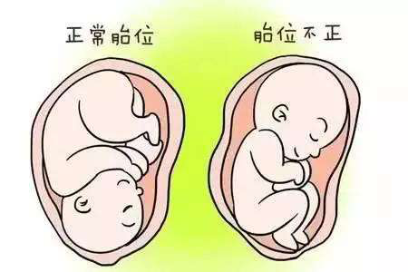 紧接着胎肩也逐渐下降旋转,当胎肩降到会阴,胎头到达耻骨联合水平