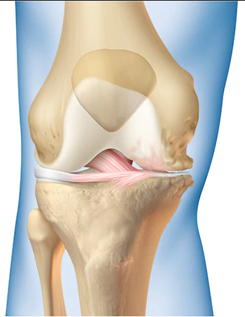 膝关节炎要不要做关节镜清理