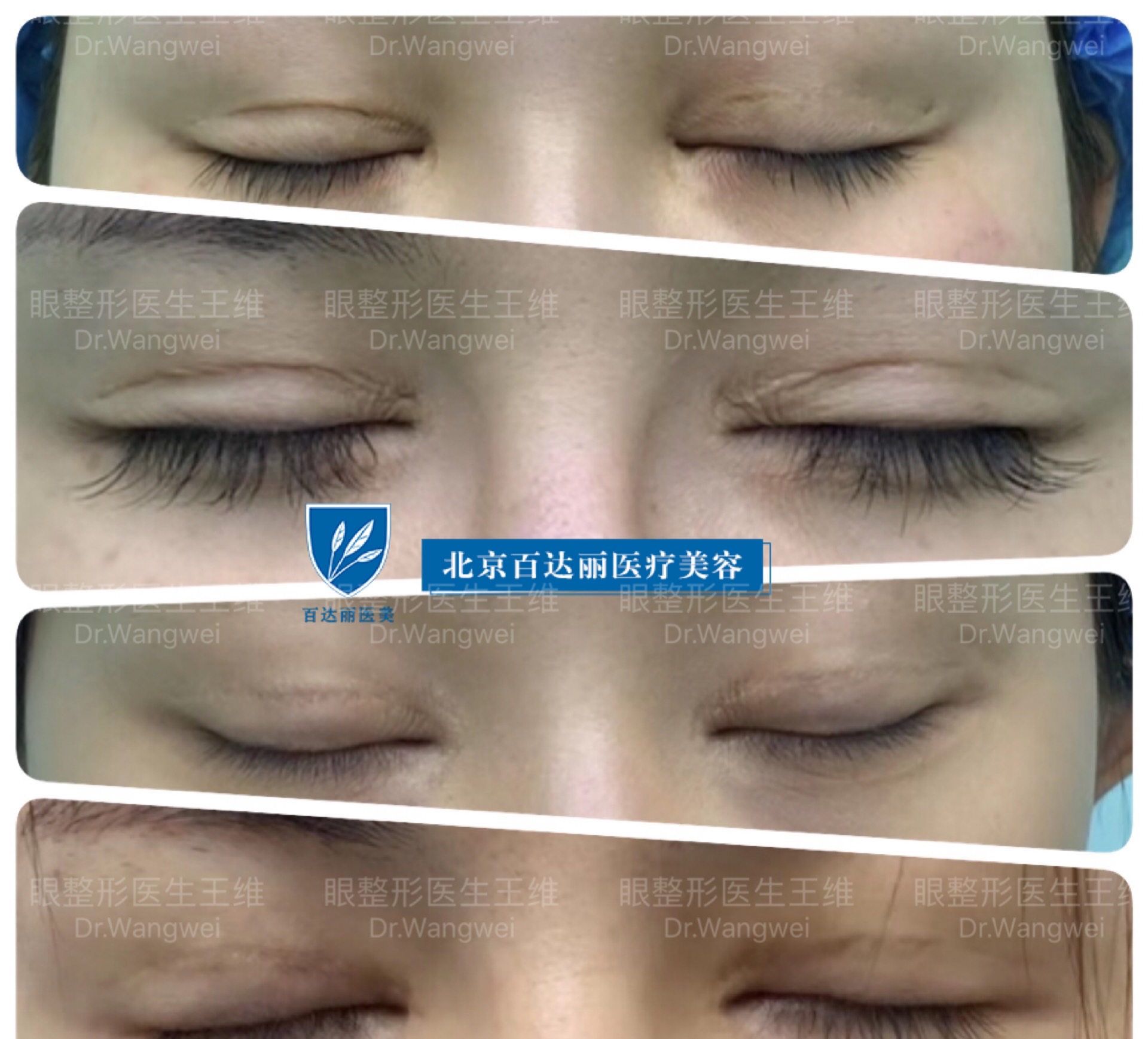 双眼皮板结怎么办?-王维-爱问医生