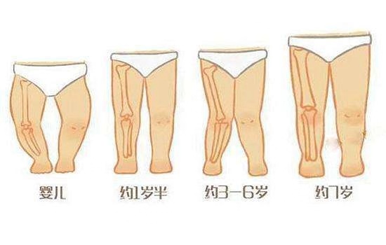 通常情况下是家族遗传,佝偻病,先天性骨骺发育畸形,骨骺不对称损伤