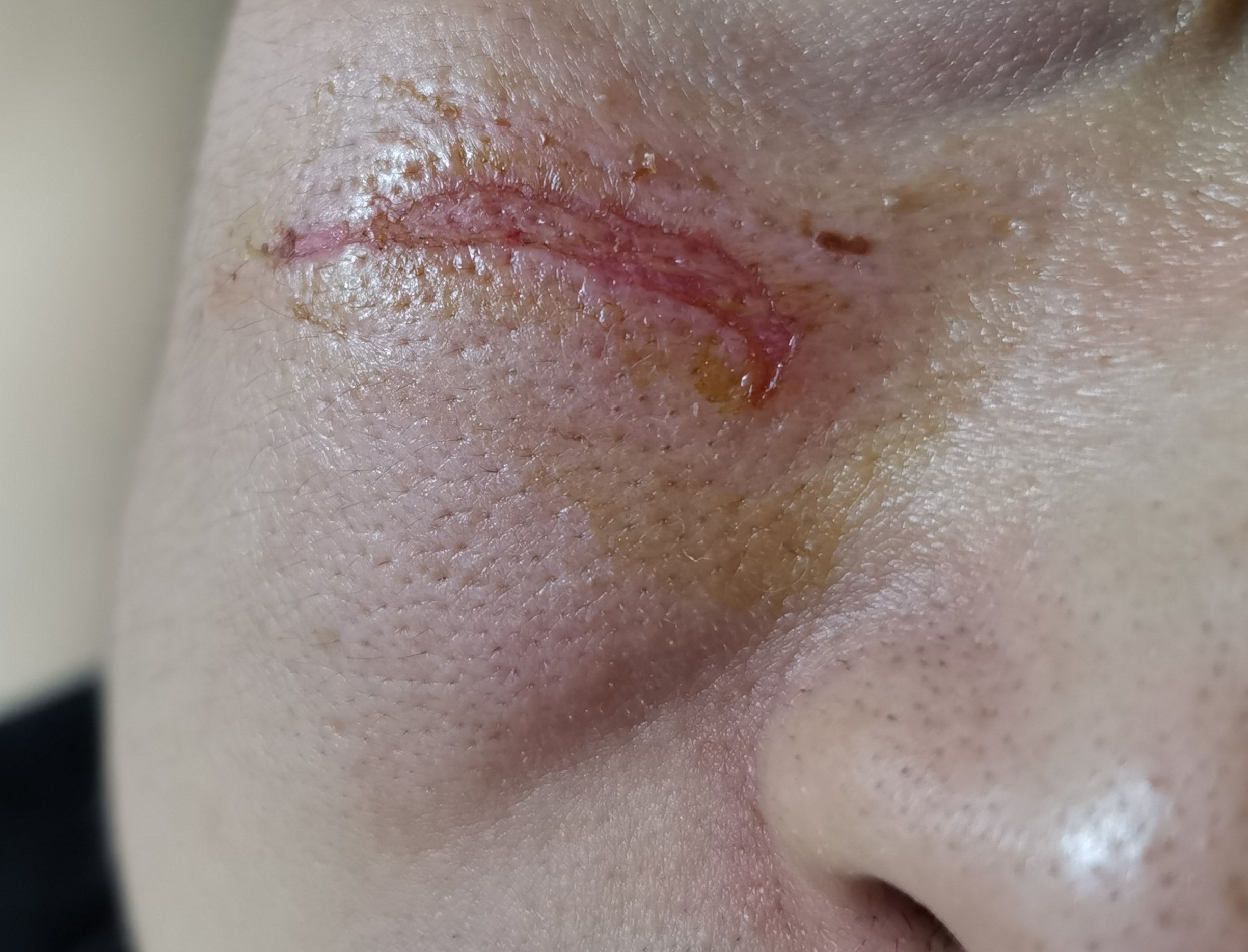 请问有什么办法可以促进愈合不留疤痕日常怎么护理