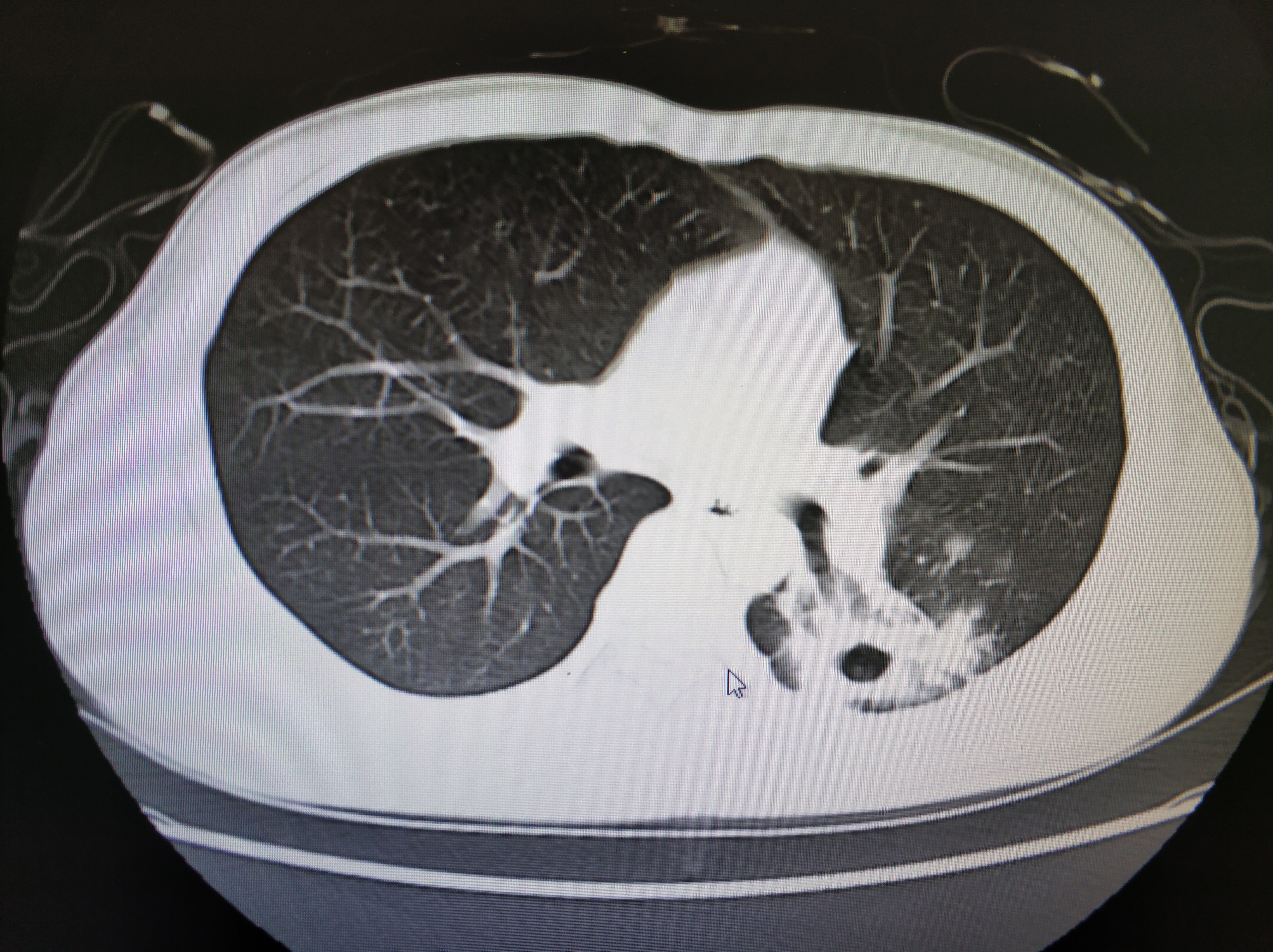 年轻人慢性咳嗽要注意肺结核的可能性