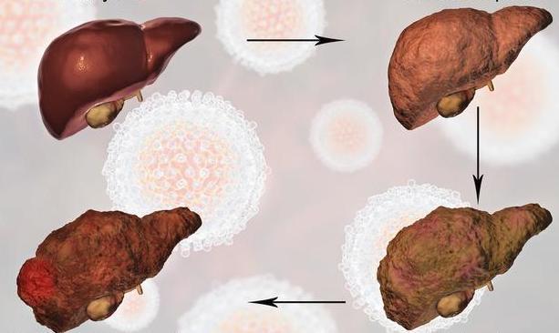 肝细胞癌的发病机制与治疗进展-车旭主任医师-爱问医生