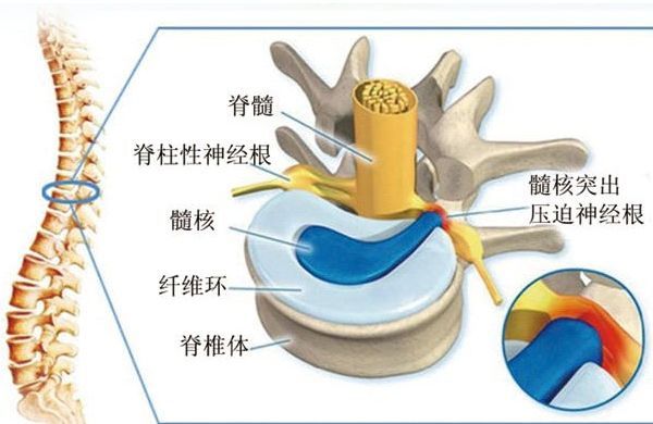 预防腰椎间盘突出刻不容缓!