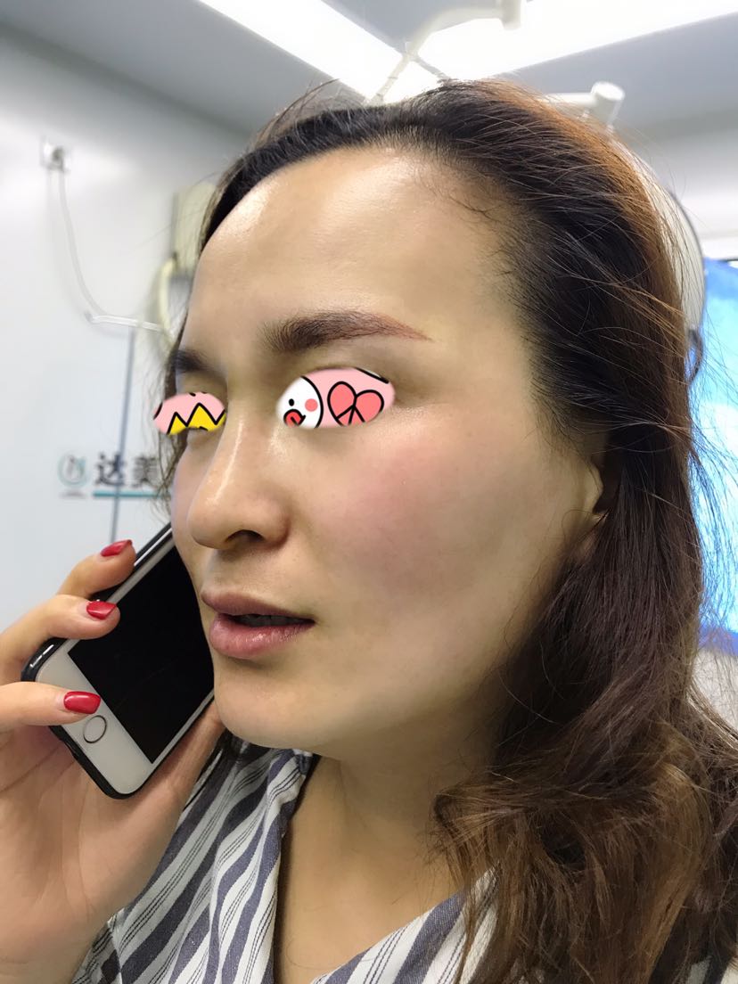奥美定取出