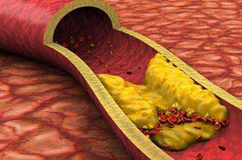 高胆固醇能血脂吃甘油三酯吗_我血脂高胆固醇高甘油三酯高不能吃什么_胆固醇高甘油三酯高能不能吃